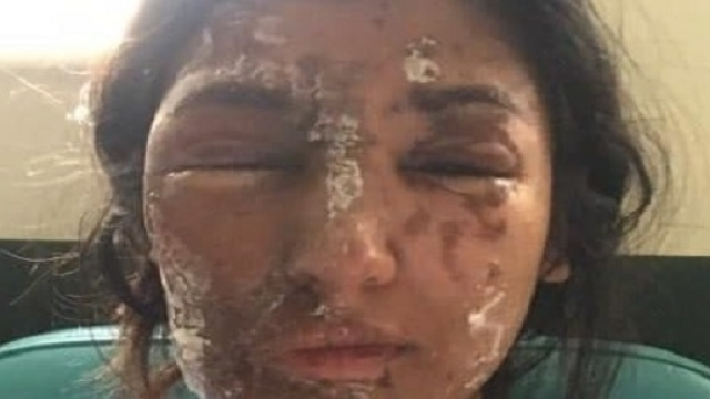Resham Khan, 21 anni, vittima di un attacco con l'acido.