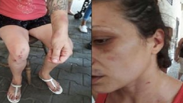 La signora Pamela mostra i lividi e le escoriazioni rimediate