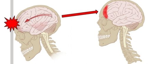 This is how concussions work. Max Andrews via Wikimedia Commons
