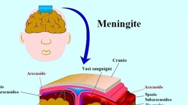 Sintomi della meningite virale e batterica,cause e terapia - fisioterapiarubiera.com