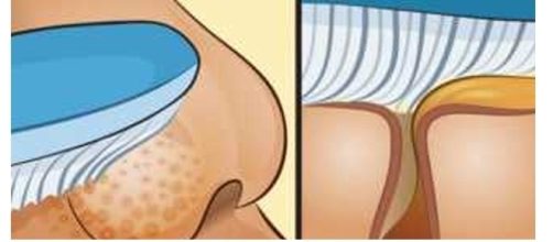 Como remover cravos e espinhas