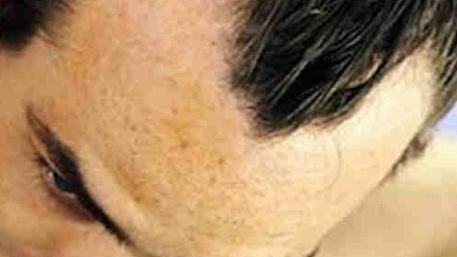 Calvizie o caduta dei capelli, un frutto che fa ricrescere i capelli
