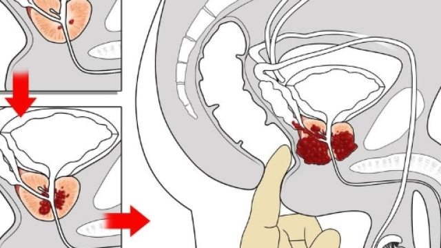 Sorveglianza attiva del cancro alla prostata: quali sono gli esami ... - my-personaltrainer.it