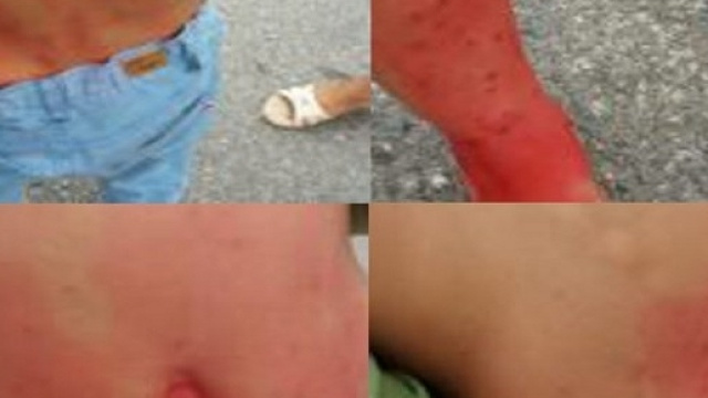 Le piaghe presenti sul corpo dei bambini del campo nomadi di Castel Romano.