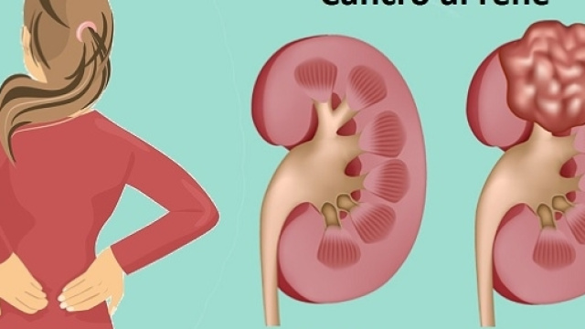 Risultati sorprendenti dall&rsquo;onco-immunologia nel cancro al rene.