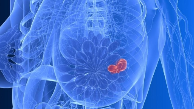 Tumore al seno, ma la credono stressata