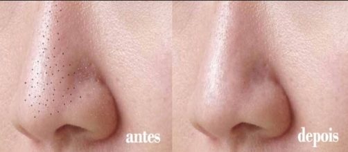 Confira como remover cravos com facilidade