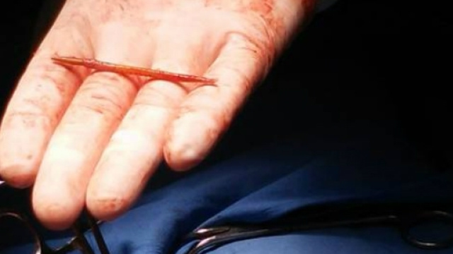 Uomo ricoverato con uno stuzzicadenti nel cuore
