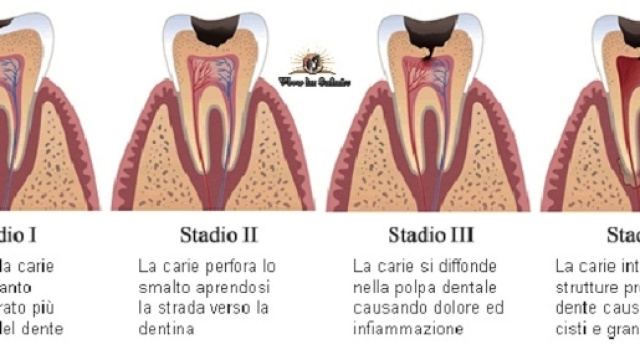 Cina, scoperto vaccino che potrebbe contrastare l'insorgere della carie.