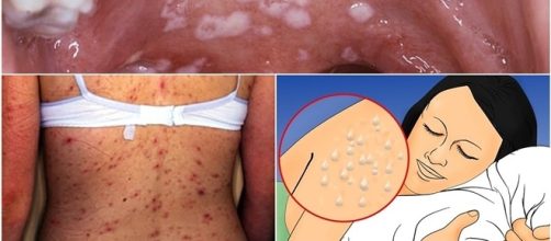 Os sintomas da Aids que muitos Ignoram