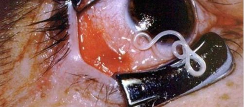 Olho humano acometido por verme