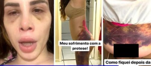 Youtuber Camilla Uckers fica &agrave; beira da morte ap&oacute;s pr&oacute;tese e fotos chocam