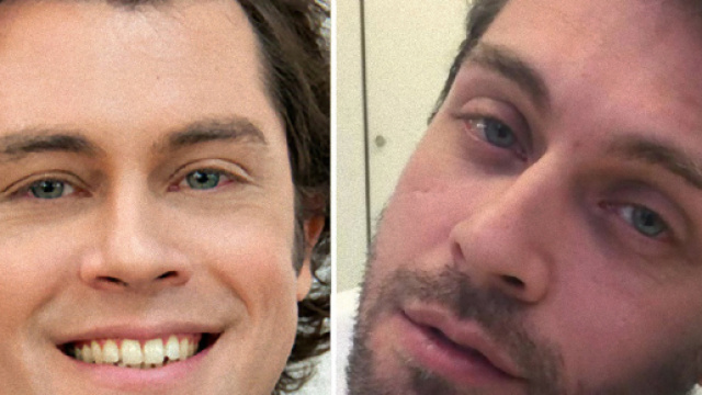 Quanto ha speso Raffaello Tonon per fare l&rsquo;intervento di liposcultura?