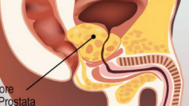 Tumore alla prostata il ruolo dei grassi cattivi
