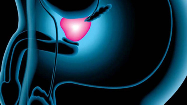 Scoperta una terapia contro il cancro alla prostata