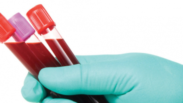 Test per il Cancro, con un prelievo del sangue si riconosceranno 8 tumori