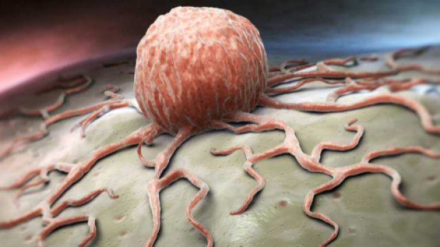 Il diabete di tipo 1 &egrave; legato al rischio di una vasta gamma di tumori