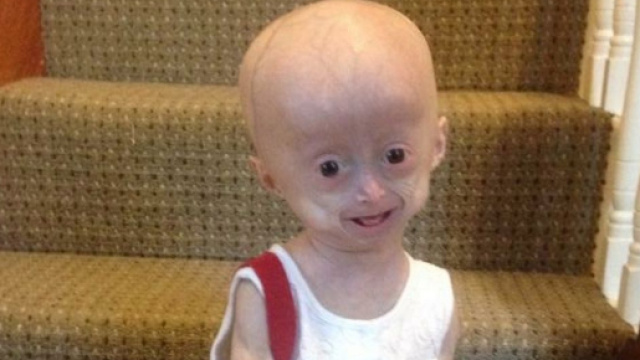 Lucy Parker aveva 8 anni ma sembrava una minuscola vecchina per una rara malattia al momento incurabile. Foto: Facebook.