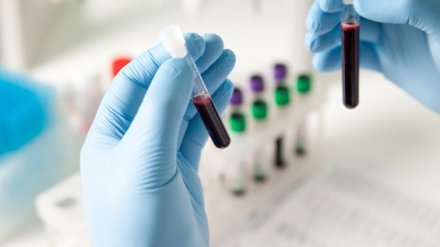 CancerSEEK: test universale per scoprire 8 tipi di tumore - dhakatribune.com