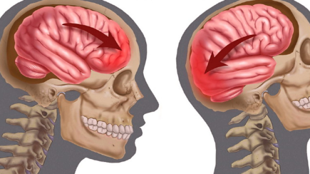 Encefalopatia traumatica cronica: cos'&egrave; e quali sport sono a ... - medicinaonline.co