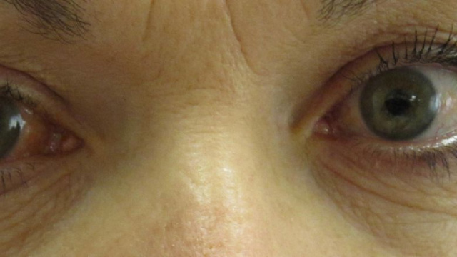 Soffri di Glaucoma? Una persona su due non sa di avere la patologia