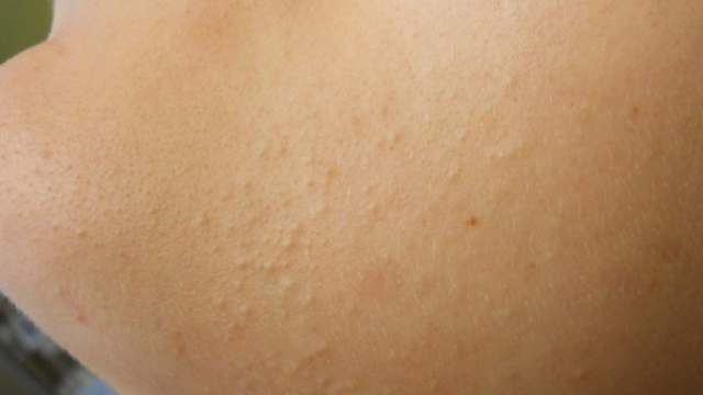 Brufolo si trasforma in un tumore di 5 chili