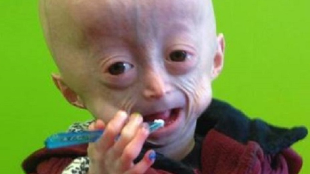 La piccola Lucy affetta da una rarissima malattia