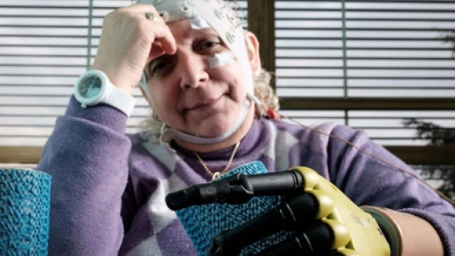 Impiantata mano bionica in una donna veneta - avvenire.it