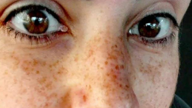 E' morta Vanessa Gasparro la ragazza che raccont&ograve; la sua malattia al web