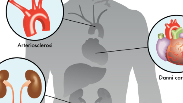 Diabete di tipo 2: scoperto farmaco che riduce rischio di infarto e ictus