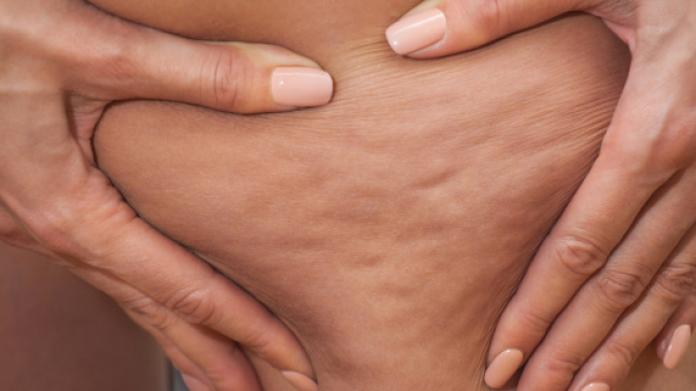 La cellulite pu&ograve; essere eliminata attraverso alcuni accorgimenti