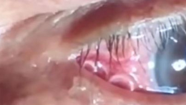 Avverte dolore all'occhio, scopre di avere un verme di 15 centimetri