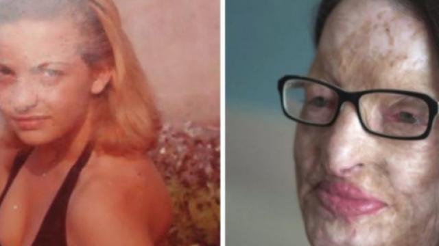 Filomena, sfigurata con l'acido: 'Lui &egrave; libero, a me l'INPS ha sospeso la pensione'