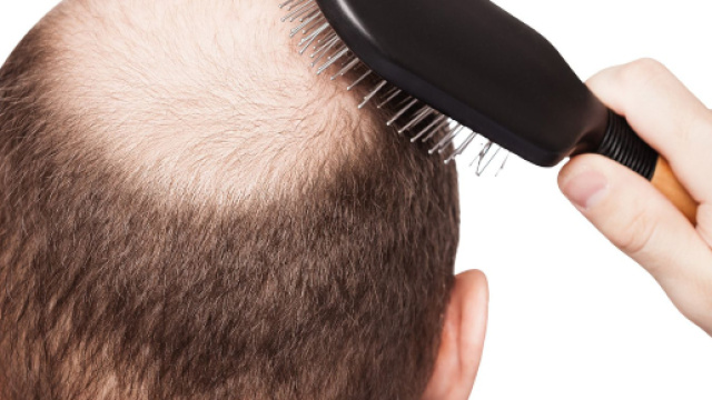 Alcuni rimedi per far fronte alla caduta dei capelli