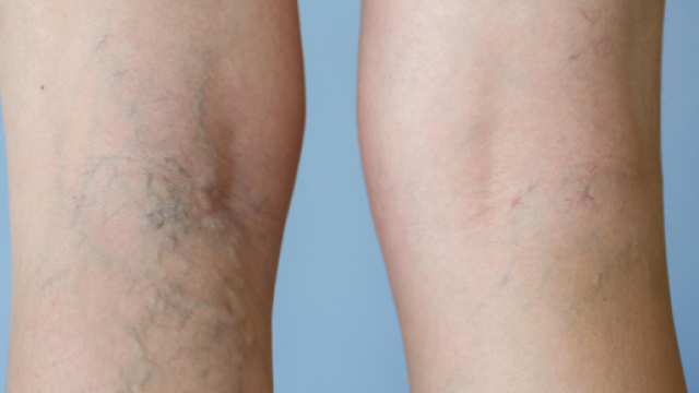 Alcuni rimedi naturali per la cura delle varici.