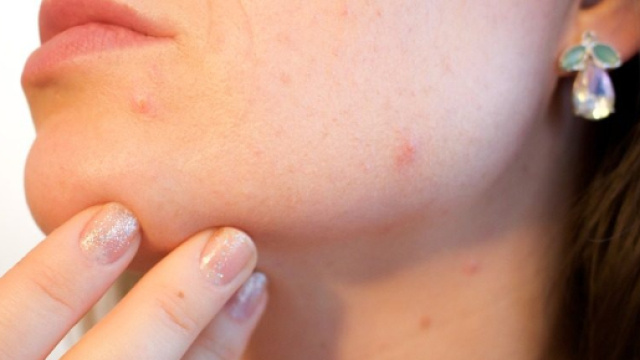 Alcuni consigli per combattere l'acne