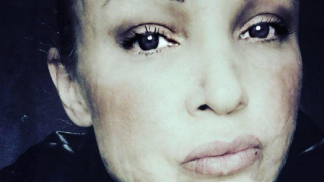 Cristina Guidetti, ex modella sfigurata da un intervento di chirurgia estetica: dopo quasi sette anni neanche un euro di risarcimento.