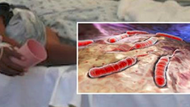 Casi di colera a Napoli. Dalle feci al vomito, come riconoscere i sintomi della malattia - Internapoli