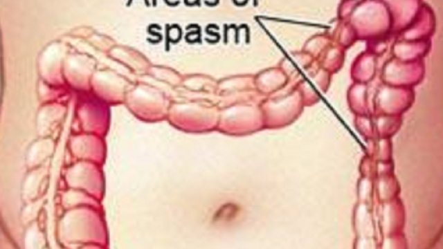 Sindrome del colon irritabile e dieta FODMAP