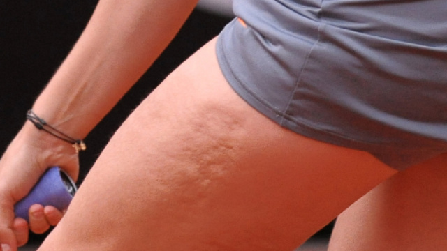 Endo: primo farmaco anti cellulite entro il 2020