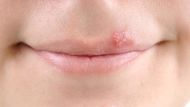 Alcuni consigli per curare l'herpes labiale.