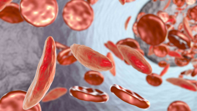 Alcuni rimedi per far fronte all'anemia da carenza di ferro