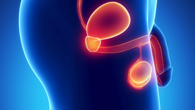 Alcuni segnali della presenza del tumore alla prostata.