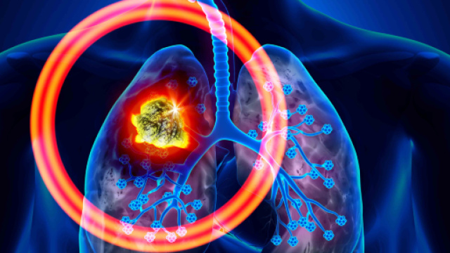 Tumore ai polmoni: alcuni segnali.