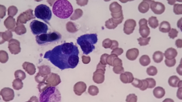 Alcuni fattori di rischio del mieloma multiplo.