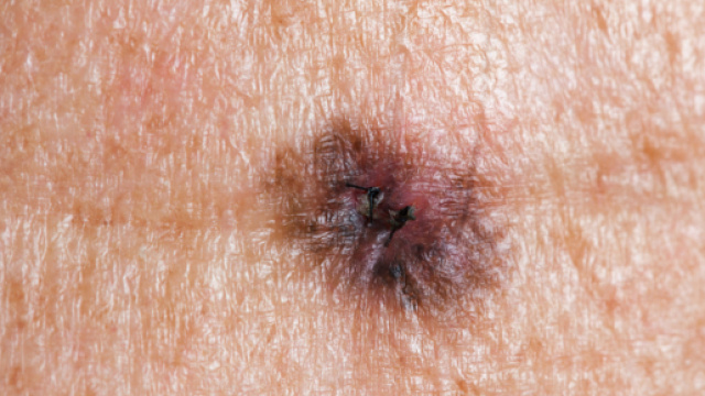 Il melanoma: alcuni campanelli d'allarme.