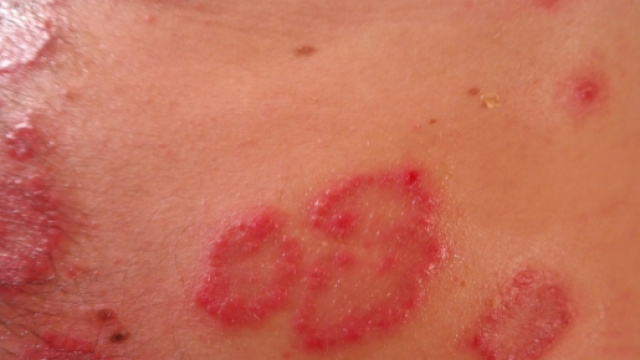 Scabbia due nuovi casi nel modenese