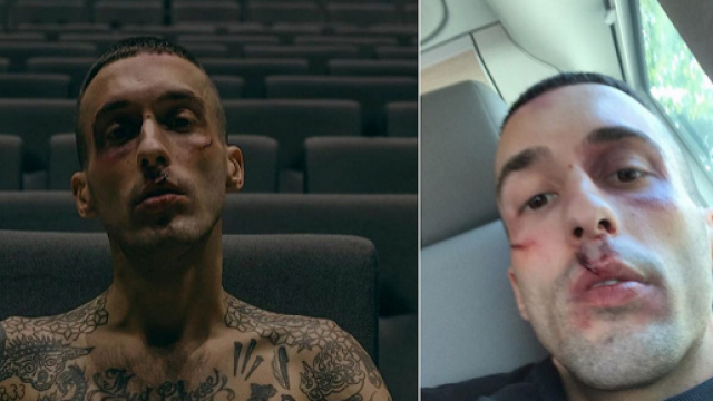 Jamil mostra i tagli sul volto e prende in giro gli haters