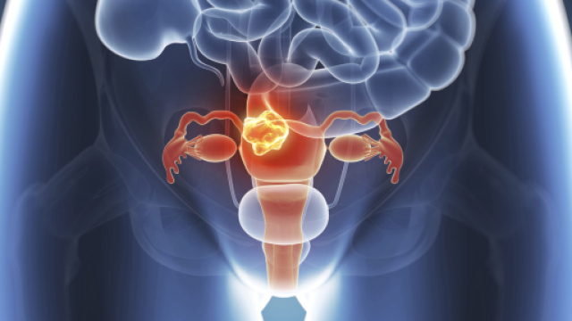 Alcune buone abitudini per la prevenzione del tumore alla vescica.