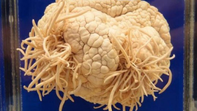 Ameba mangia cervelllo ha provocato la morte di una donna infettata dall'acqua del rubinetto con cui faceva irrigazioni al naso per la sinusite.